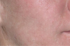 Resultado tratamiento acné láser 1540
