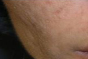 Resultado tratamiento de acne IPl MAX-G