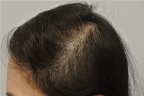 Resultado en alopecia con PRP