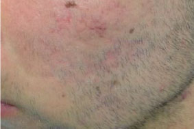 Después de tratamiento para acné con láser 1540